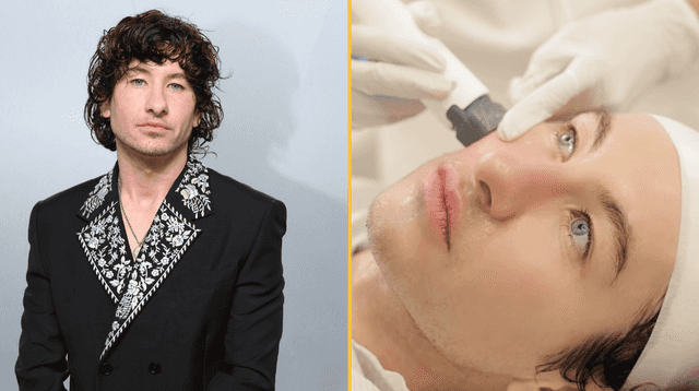 Barry Keoghan admits undergoing cosmetic treatment after online abuse Barry Keoghan admits undergoing cosmetic treatment after online abuse